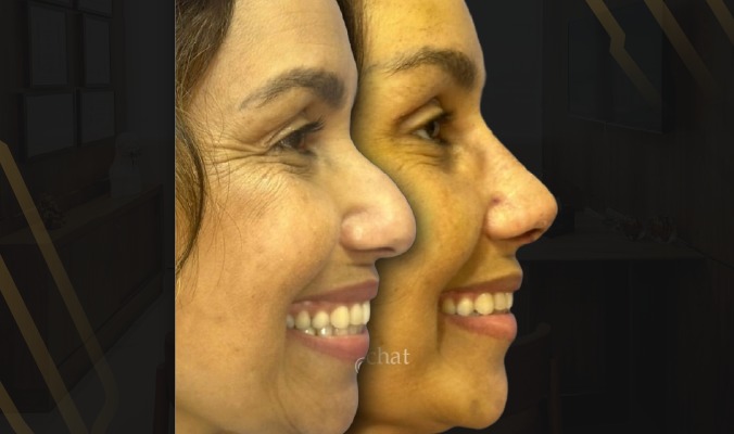 Bannerthoof122124512V